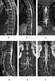 This means the bacteria are easily spread from an infected person to someone else. Differentiation Of Intraspinal Tuberculosis And Metastatic Cancer Usin Idr