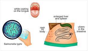 Lecture on salmonella will explain general properties, infection,disease, pathogenesis and treatment related to salmonella bacteria. Typhoid Treatment