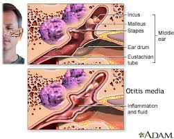However, it will not cause harm to the ear either. Ear Infection Middle Ear Otitis Media Symptoms And Causes