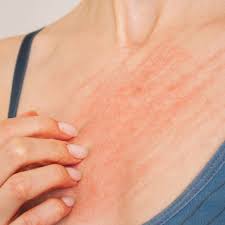Image result for Scabies