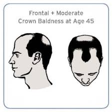 It usually settles down for a bit until they get into their later 40's to around the 50's. Fallout From New Study Men With Early Balding May Be At Higher Risk Of Aggressive Prostate Cancer Prostate Cancer Foundation