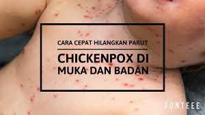 Apr 18, 2018 · makanan masin. Cara Cepat Hilangkan Parut Chickenpox Di Muka Dan Badan Sihat Itu Nikmat