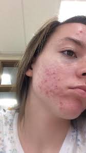 In a clinical study, patients reported up to an 87% decrease in acne after 12 weeks of use. Adapalene Topical Retinoid Acne Treatment Differin Gel