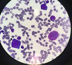 Pure red cell aplasia is a kind of anemia that affects the red blood cells. Pure Red Cell Aplasia And Hiv Infection What To Suspect Bmj Case Reports