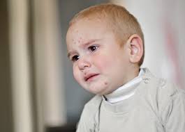 Intense itching — and the scratching it causes — lead to the symptoms of neurodermatitis, a common type of eczema that affects about 12% of the population. Kinder Mit Neurodermitis Leiden Besonders Stark