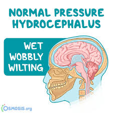 Image result for Normal Pressure Hydrocephalus