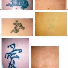 Worth, tx, we use the world's most advanced tattoo removal lasers, the astanza etherea mx laser and astanza eternity ruby laser. A The First Freedom 2 Tattoo Is Being Placed In The Arm Of The Ceo Of Download Scientific Diagram