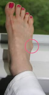 I was in severe pain, hard to put weight on it and was walking with a limp. Ganglion Cysts On Feet Northwest Foot Care Dr Frank Cobarrubia Northwest Foot Care