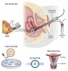 Therefore, it is important that each patient. In Vitro Fertilization Boca Raton Aventura Fl
