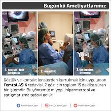 Gozluk Ve Kontakt Lenslerden Kurtulmak Icin Uygulanan Femtolasik Tedavisi 2 Goz Icin Toplam 15 Dakika Suren Bir Islemdir Bu Yontemle Miyo Bilgi Gozler Gozluk