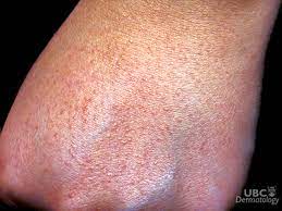 The most common form of sun allergy is polymorphic light eruption, also known as sun poisoning. Ask An Expert Can I Become Allergic To The Sun Vch Research Institute