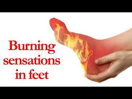 Pin On Home Remedies For Burns