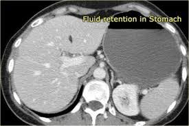 Pin By Pavol Telek On 101 E Vyber Grafika Small Bowel Obstruction Bowel Obstruction Large Bowel