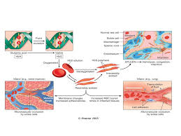 Sgugenetics Pathophysiology Of Sickle Cell Anemia