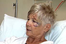 Sydney cyclist loses function in hand after collision with car