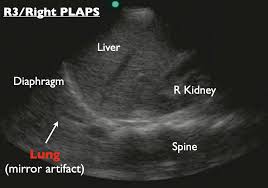 Learn step 2 and shelf essentials in a free 10 min video. Pocus 101 On Twitter 10 The Curtain Sign Is Seen In Healthy And Aerated Lungs At Plaps Point An Aerated Lung Is Like A Curtain Because As It Fills With Air It