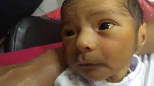 Ictericia En Neonato Hiperbilirrubinemia Neonatal Youtube