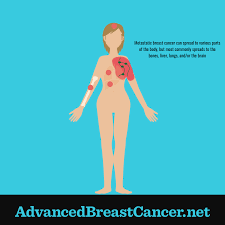 Chest wall pain can have a number of causes, including: Where And How Does Metastatic Breast Cancer Spread