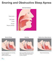 Snoring And Obstructive Sleep Apnea Premium Vision Surgical Centres