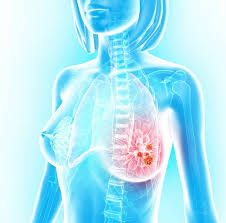 Few woman know those spots exists. Test Predicts Woman S Chance Of Surviving Breast Cancer Daily Mail Online