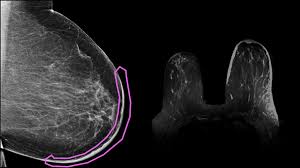 Is there a clinical trial i can join? Practice Cases Mammoguide Learn Breast Imaging