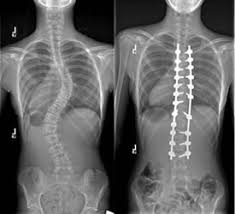 5 Reasons To Rehab After Scoliosis Surgery Align Therapy