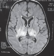 Herpes simplex encephalitis (hse) is an inflammation of the brain parenchyma, typically in the medial temporal it is the most common cause of fatal sporadic encephalitis in the us. Acute Viral Encephalitis Clinical Features And Outcome Experience From A Tertiary Center Of North India