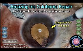 Image result for Coloboma