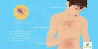 Paratifus Merupakan Penyakit Yang Disebabkan Infeksi Bakteri Salmonella Paratyphi Penyakit Paratifus Mirip Dengan Tipes Dengan Tingkat K Penyakit Sumsum Tulang