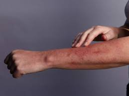 One of the most commonly reported side effects of the vaccine was a red, itchy rash at the injection site known as covid arm or moderna arm, as 95 percent of cases are reported in patients who receive the company's vaccine.while this has been previously reported as a side effect, the study did find that only 43 percent of patients who developed a rash on their. Skin Complications Post Vaccination Reported In Some People Say Dermatologists The Economic Times