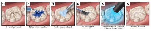 Enrollees who have ever received sealants on all permanent second molars. Dental Sealants In South Fort Worth Arlington Abram Dental