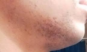The latest scar removal treatments to minimize or change the appearance of your scar. Pin On Skin Care
