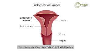When periods have there are many causes of postmenopausal bleeding and normally it is benign (not due to cancer) a common symptom of endometrial hyperplasia is abnormal bleeding after menopause, which may or. What Is Uterine Cancer Endometrial Cytecare