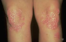 Image result for psoriasis