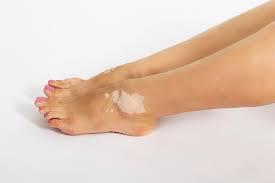 See full list on mayoclinic.org Vitiligo Su Impacto Estetico Psicologico Y Social Colvenfar