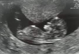 Pregnancy Ultrasound Dating Accuracy Url To