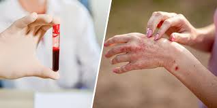 Image result for Rheumatoid Factor