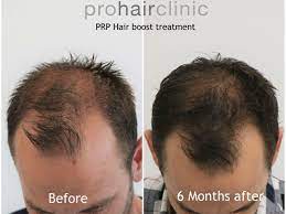 The treatment provides excellent results, and these results can be improved further by combining it with other treatments. Prp Treatment Against Hair Loss Visible Results Prohair Clinic