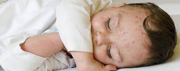 Beberapa perusahaan susu formula bahkan mengirim sampel gratis sehingga bayi tidak perlu. Identifikasi Gejala Awal Alergi Susu Sapi Pada Bayi Nutriclub Nutriclub