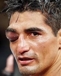 It was very difficult fighting with only one eye. [But] I'm Mexican. I will  never quit."