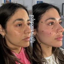 IGLOW MED SPA