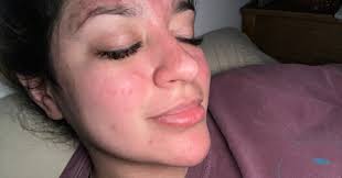 Lupus Foundation of America