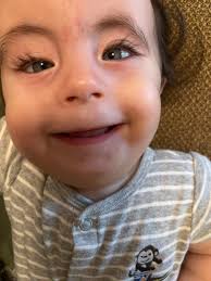 When Baby Xander was diagnosed with Trisomy 18, his parents were told he  would never survive. He did. Xander's family was able to find the care they  needed, and he has since