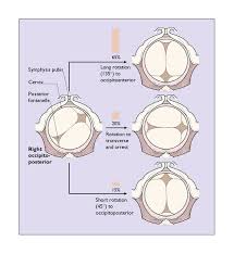 Image result for Manual Rotation in Occipitoposterior Presentation