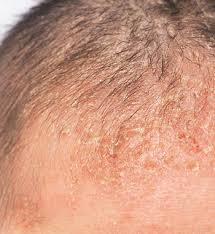Image result for Seborrheic Dermatitis