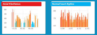 ai equipped apple watch can detect irregular heartbeat and