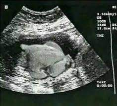 Turkey Ultrasound I M Having A Turkey 11 27 14 Lol Ultrasound Getting Pregnant Fake Ultrasound