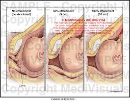 Effacement Medical Illustration Medivisuals