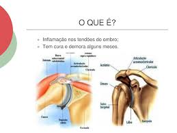 PPT - TENDINITE NO OMBRO PowerPoint Presentation, free download - ID:3412591