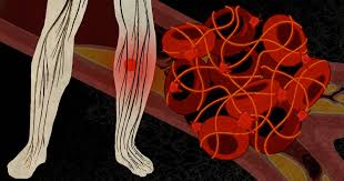 Symptoms of bone marrow cancer signs and symptoms of multiple myeloma may include: Blood Clots What Cancer Patients Need To Know